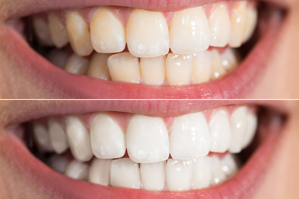 4 Teeth-Whitening Procedures