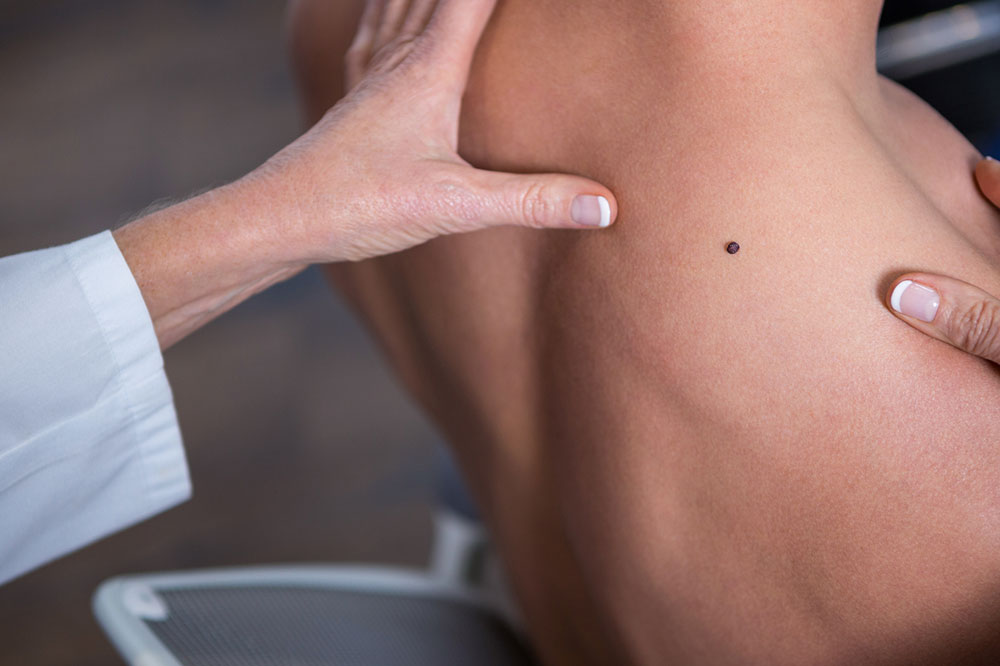 Warning Signs of Melanoma and How to Self-diagnose