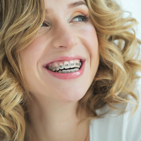 The Advantages of Clear Aligners Vs. Traditional Metal Braces