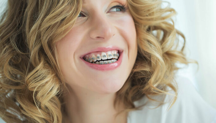 The Advantages of Clear Aligners Vs. Traditional Metal Braces